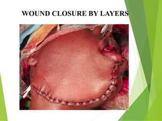 WOUND CLOSURE BY LAYERS
 
