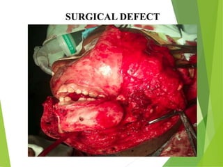 SURGICAL DEFECT
 