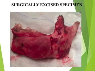 SURGICALLY EXCISED SPECIMEN
 