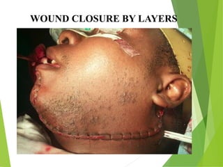 WOUND CLOSURE BY LAYERS
 