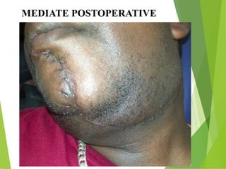 MEDIATE POSTOPERATIVE
 