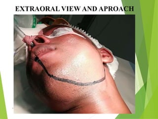 09/30/17
www.stuffamia.com
EXTRAORAL VIEW AND APROACH
 