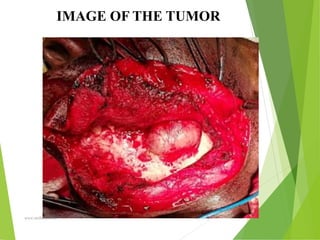 09/30/17
www.stuffamia.com
IMAGE OF THE TUMOR
 