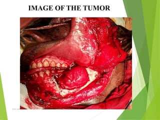 09/30/17
www.stuffamia.com
IMAGE OF THE TUMOR
 