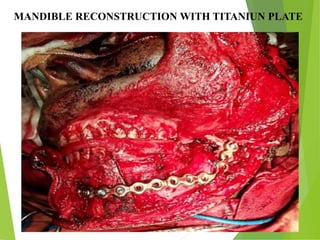 09/30/17
www.stuffamia.com
MANDIBLE RECONSTRUCTION WITH TITANIUN PLATE
 