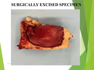 09/30/17
www.stuffamia.com
SURGICALLY EXCISED SPECIMEN
 