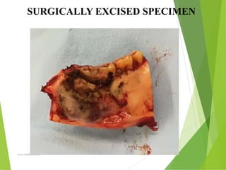 09/30/17
www.stuffamia.com
SURGICALLY EXCISED SPECIMEN
 