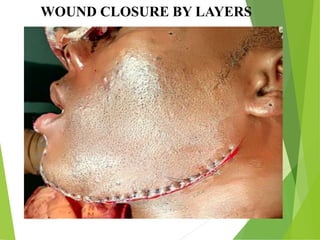 09/30/17
www.stuffamia.com
WOUND CLOSURE BY LAYERS
 