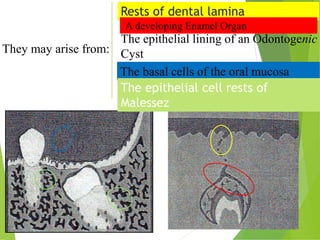 They may arise from:
Rests of dental lamina
A developing Enamel Organ
The epithelial lining of an Odontogenic
Cyst
The basal cells of the oral mucosa
The epithelial cell rests of
Malessez
 