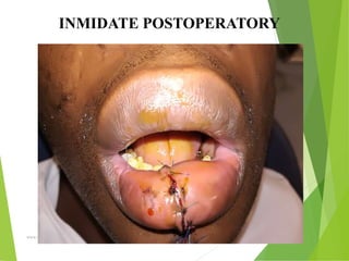 09/30/17
www.stuffamia.com
INMIDATE POSTOPERATORY
 