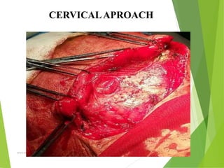 09/30/17
www.stuffamia.com
CERVICALAPROACH
 