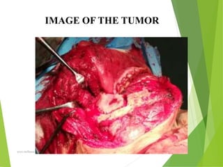 09/30/17
www.stuffamia.com
IMAGE OF THE TUMOR
 