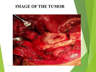 09/30/17
www.stuffamia.com
IMAGE OF THE TUMOR
 