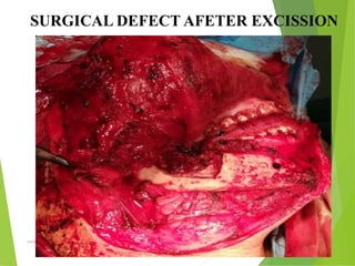 09/30/17
www.stuffamia.com
SURGICAL DEFECT AFETER EXCISSION
 