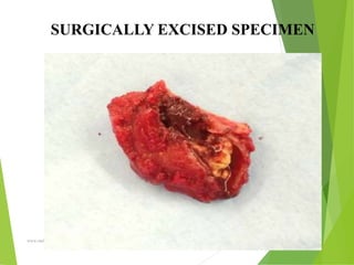 09/30/17
www.stuffamia.com
SURGICALLY EXCISED SPECIMEN
 