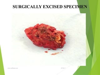 09/30/17
www.stuffamia.com
SURGICALLY EXCISED SPECIMEN
 