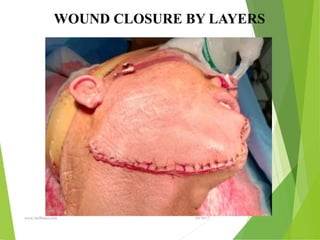 09/30/17
www.stuffamia.com
WOUND CLOSURE BY LAYERS
 