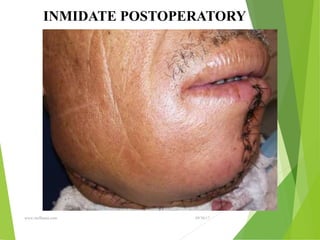09/30/17
www.stuffamia.com
INMIDATE POSTOPERATORY
 