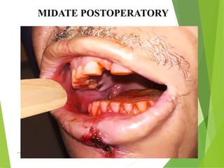 09/30/17
www.stuffamia.com
MIDATE POSTOPERATORY
 