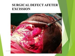 09/30/17
www.stuffamia.com
SURGICAL DEFECT AFETER
EXCISSION
 