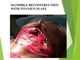 09/30/17
www.stuffamia.com
MANDIBLE RECONSTRUCTION
WITH TITANIUN PLATE
 