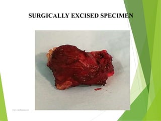 09/30/17
www.stuffamia.com
SURGICALLY EXCISED SPECIMEN
 