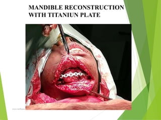 09/30/17
www.stuffamia.com
MANDIBLE RECONSTRUCTION
WITH TITANIUN PLATE
 
