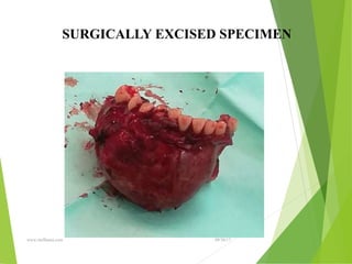 09/30/17
www.stuffamia.com
SURGICALLY EXCISED SPECIMEN
 