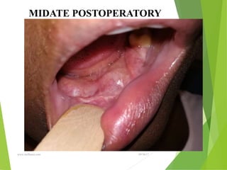 09/30/17
www.stuffamia.com
MIDATE POSTOPERATORY
 