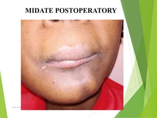 09/30/17
www.stuffamia.com
MIDATE POSTOPERATORY
 