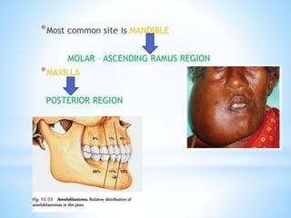 AMELOBLASTOMA [op].pptx