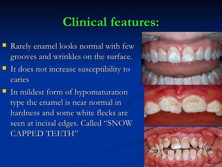 Amelogeneis Imperfecta