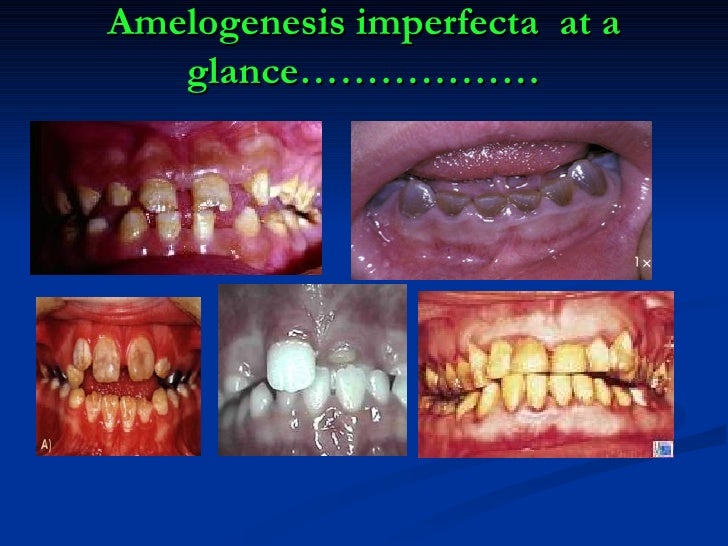 amelogenesis imperfecta at a glance