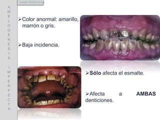 Color anormal: amarillo,
marrón o gris.
Baja incidencia.
A
M
E
L
O
G
É
N
E
S
I
S
I
M
P
E
R
F
E
C
T
A
CARACTERÍSTICAS
Sólo afecta el esmalte.
Afecta a AMBAS
denticiones.
 
