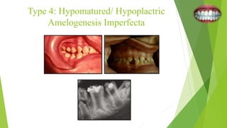 Type 4: Hypomatured/ Hypoplactric
Amelogenesis Imperfecta
 