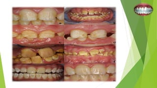 Amelogenesis imperfecta