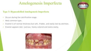 Amelogenesis Imperfecta
Type 3: Hypocalcified Amelogenesis Imperfecta
 Occurs during the calcification stage.
 Most common type.
 Enamel is of normal thickness but soft, friable, and easily lost by attrition.
 Enamel appears dull, lustrous, honey colored and stains easily.
 