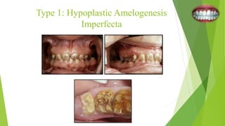 Type 1: Hypoplastic Amelogenesis
Imperfecta
 