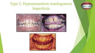 Type 2: Hypomaturation Amelogenesis
Imperfecta
 