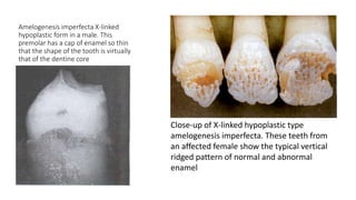 Amelogenesis imperfecta X-linked
hypoplastic form in a male. This
premolar has a cap of enamel so thin
that the shape of the tooth is virtually
that of the dentine core
.
Close-up of X-linked hypoplastic type
amelogenesis imperfecta. These teeth from
an affected female show the typical vertical
ridged pattern of normal and abnormal
enamel
 