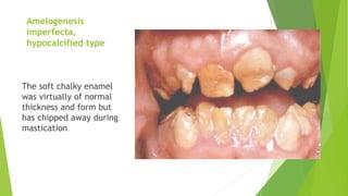 Amelogenesis
imperfecta,
hypocalcified type
The soft chalky enamel
was virtually of normal
thickness and form but
has chipped away during
mastication.
 