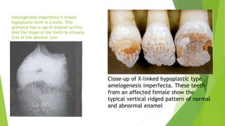 Amelogenesis imperfecta X-linked
hypoplastic form in a male. This
premolar has a cap of enamel so thin
that the shape of the tooth is virtually
that of the dentine core
.
Close-up of X-linked hypoplastic type
amelogenesis imperfecta. These teeth
from an affected female show the
typical vertical ridged pattern of normal
and abnormal enamel
 