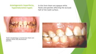 Amelogenesis imperfecta,
hypomaturation types
In this form there are opaque white
flecks and patches affecting the occlusal
half of the tooth surface.
Tooth morphology is normal but there are
opaque white and discoloured
patches.
 