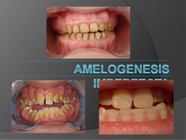 amelogenesis imperfecta