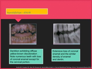 Dentition exhibiting diffuse
yellow-brown discoloration .
Note numerous teeth with loss
of coronal enamel except for
the cervical portion.
Hypocalcified type – aD & AR
Extensive loss of coronal
enamel and the similar
density of enamel
and dentin.
Neville BW, Douglass DD, Allen CM, Bouquot JE. Abnormalities of teeth. In: Oral and Maxillofacial Pathology. 2nd ed.. Pennsylvania:Elsevier;2004. 89
 