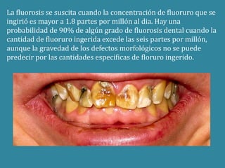 La fluorosis se suscita cuando la concentración de fluoruro que se 
ingirió es mayor a 1.8 partes por millón al dia. Hay una 
probabilidad de 90% de algún grado de fluorosis dental cuando la 
cantidad de fluoruro ingerida excede las seis partes por millón, 
aunque la gravedad de los defectos morfológicos no se puede 
predecir por las cantidades especificas de floruro ingerido. 
 