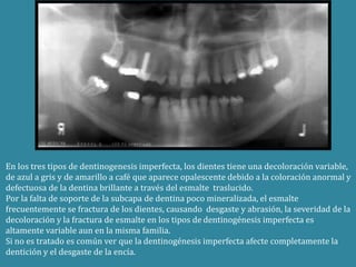 En los tres tipos de dentinogenesis imperfecta, los dientes tiene una decoloración variable, 
de azul a gris y de amarillo a café que aparece opalescente debido a la coloración anormal y 
defectuosa de la dentina brillante a través del esmalte traslucido. 
Por la falta de soporte de la subcapa de dentina poco mineralizada, el esmalte 
frecuentemente se fractura de los dientes, causando desgaste y abrasión, la severidad de la 
decoloración y la fractura de esmalte en los tipos de dentinogénesis imperfecta es 
altamente variable aun en la misma familia. 
Si no es tratado es común ver que la dentinogénesis imperfecta afecte completamente la 
dentición y el desgaste de la encía. 
 