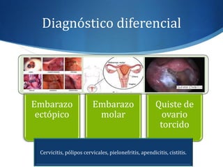 Diagnóstico diferencial
Embarazo
ectópico
Embarazo
molar
Quiste de
ovario
torcido
Cervicitis, pólipos cervicales, pielonefritis, apendicitis, cistitis.
 