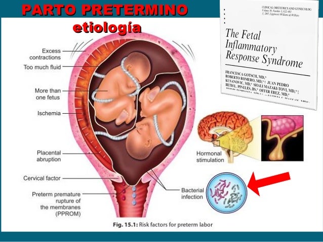 Resultado de imagen para AMENaza parto pretermino