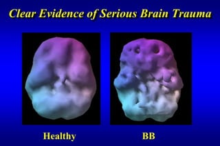 Clear Evidence of Serious Brain Trauma




      Healthy            BB
 